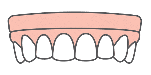 Snap-in-Dentures