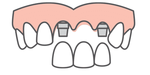 implant secured bridge icon
