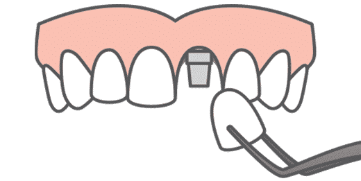 single-tooth-implant-icon
