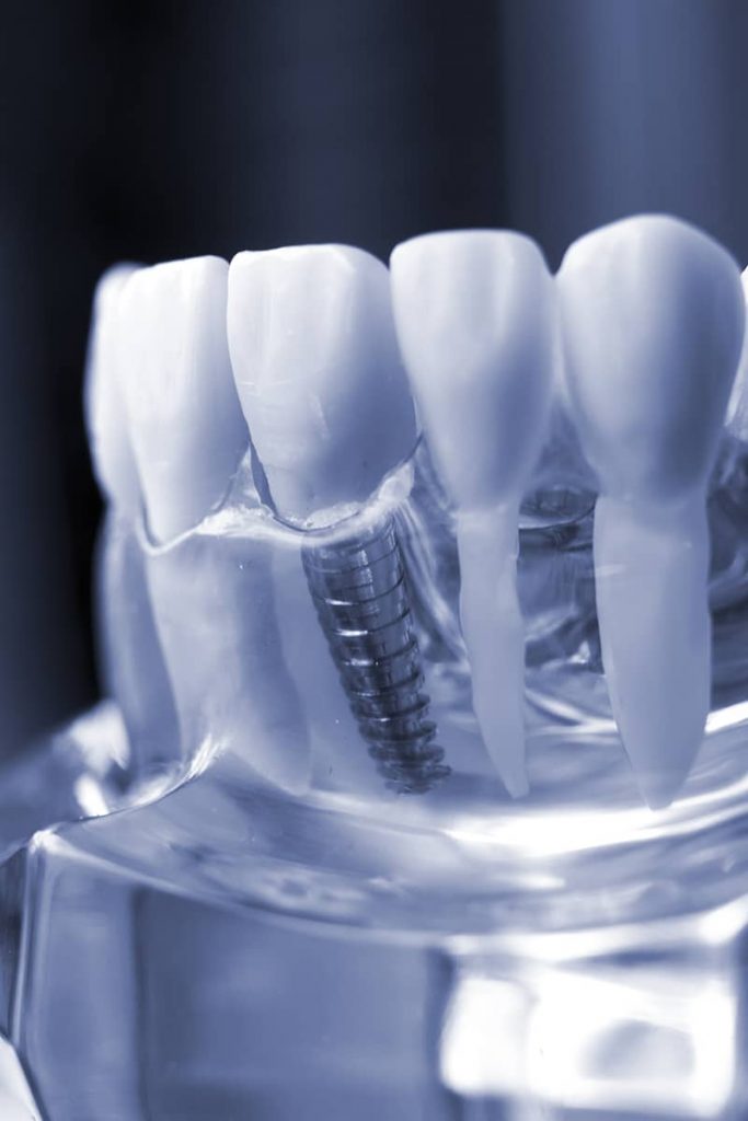 dental implants