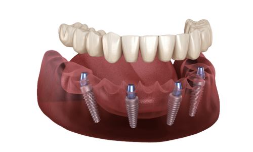 All on four fixed Zirconia