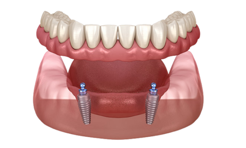 snap in overdentures