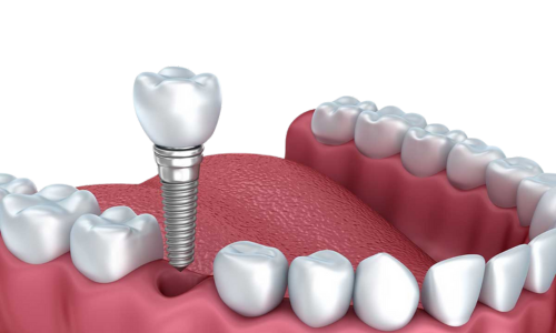 Single Dental Implant